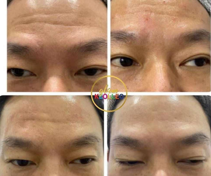 Wrinkles Removal