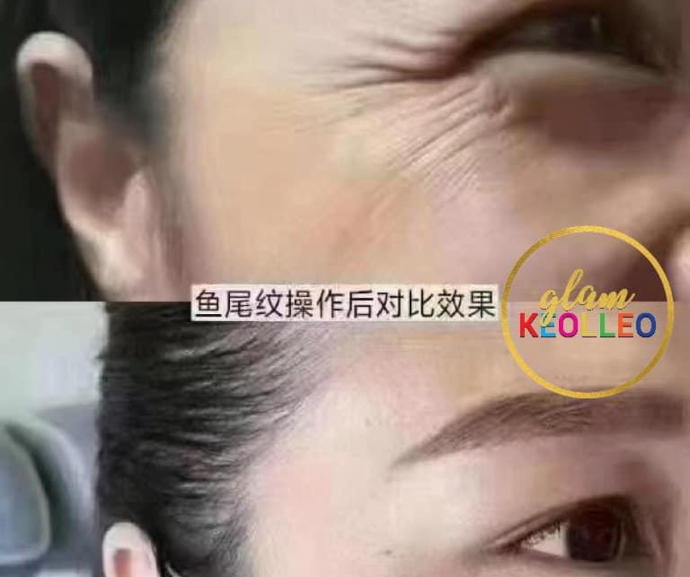 Wrinkles Removal