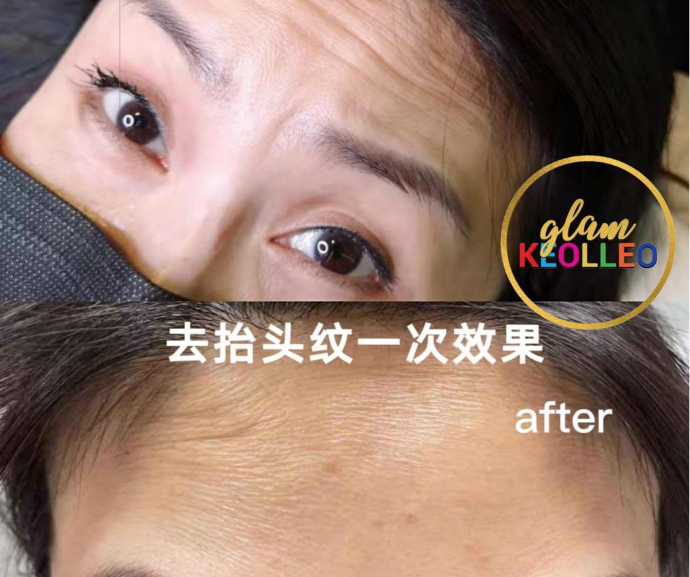 Wrinkles Removal
